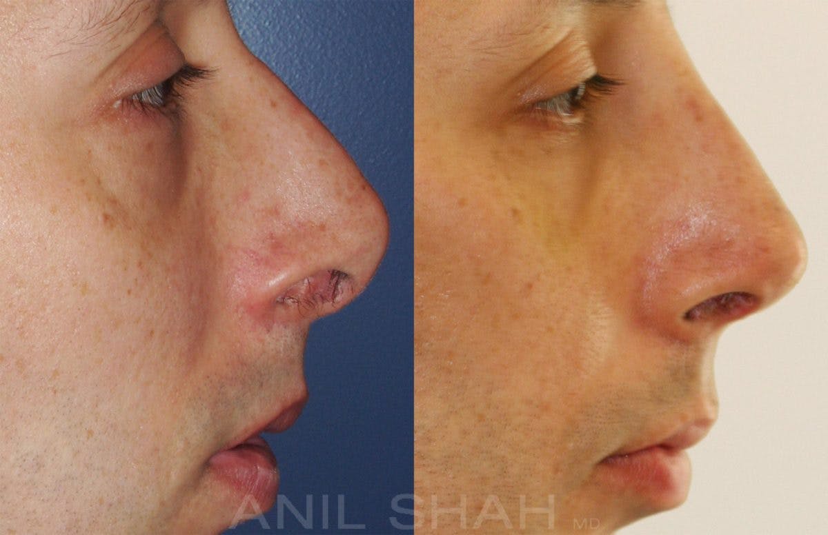 Facial Implants Before & After Gallery - Patient 383712 - Image 2