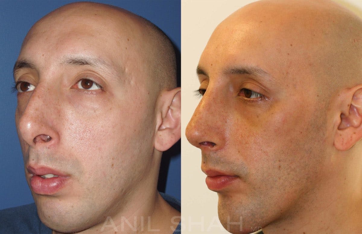 Facial Implants Before & After Gallery - Patient 383712 - Image 3