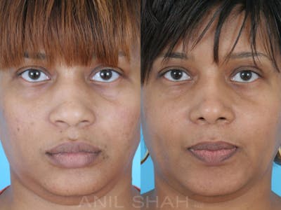 Facial Implants Before & After Gallery - Patient 198639 - Image 1