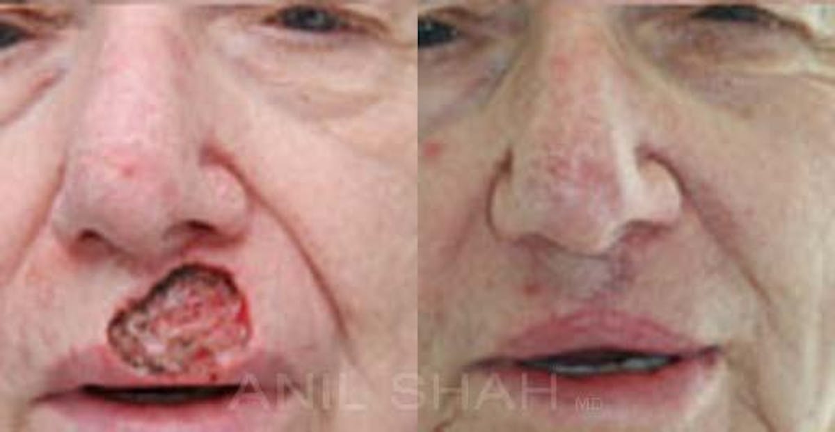 Facial Reconstruction Before & After Gallery - Patient 251822 - Image 1
