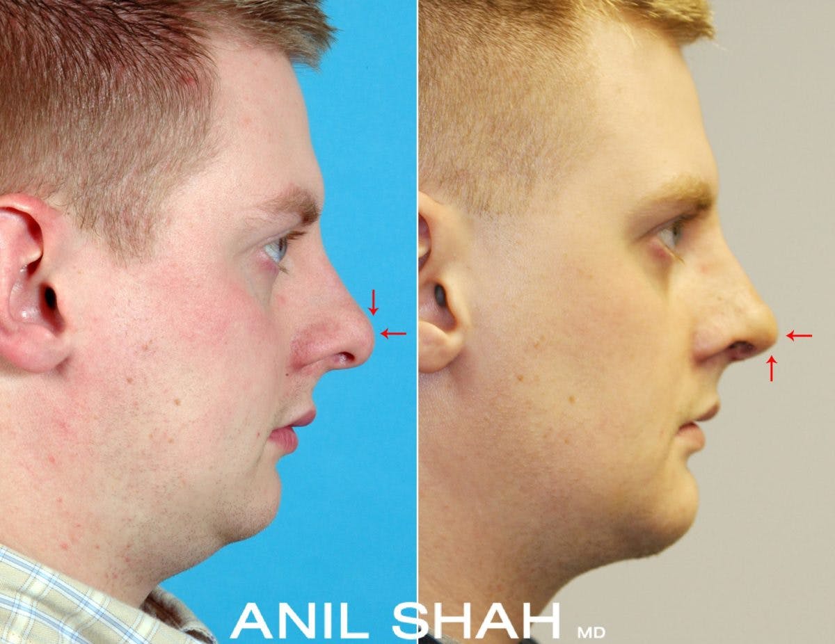 Facial Implants Before & After Gallery - Patient 119338 - Image 2
