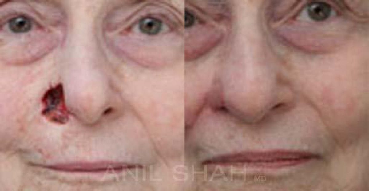 Facial Reconstruction Before & After Gallery - Patient 210852 - Image 1