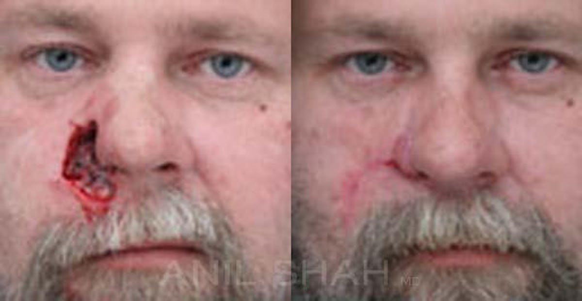 Facial Reconstruction Before & After Gallery - Patient 150097 - Image 1