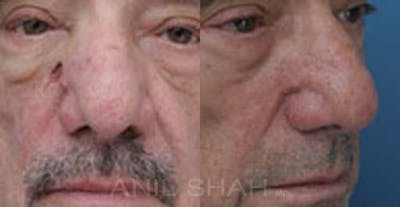 Facial Reconstruction Before & After Gallery - Patient 451354 - Image 1