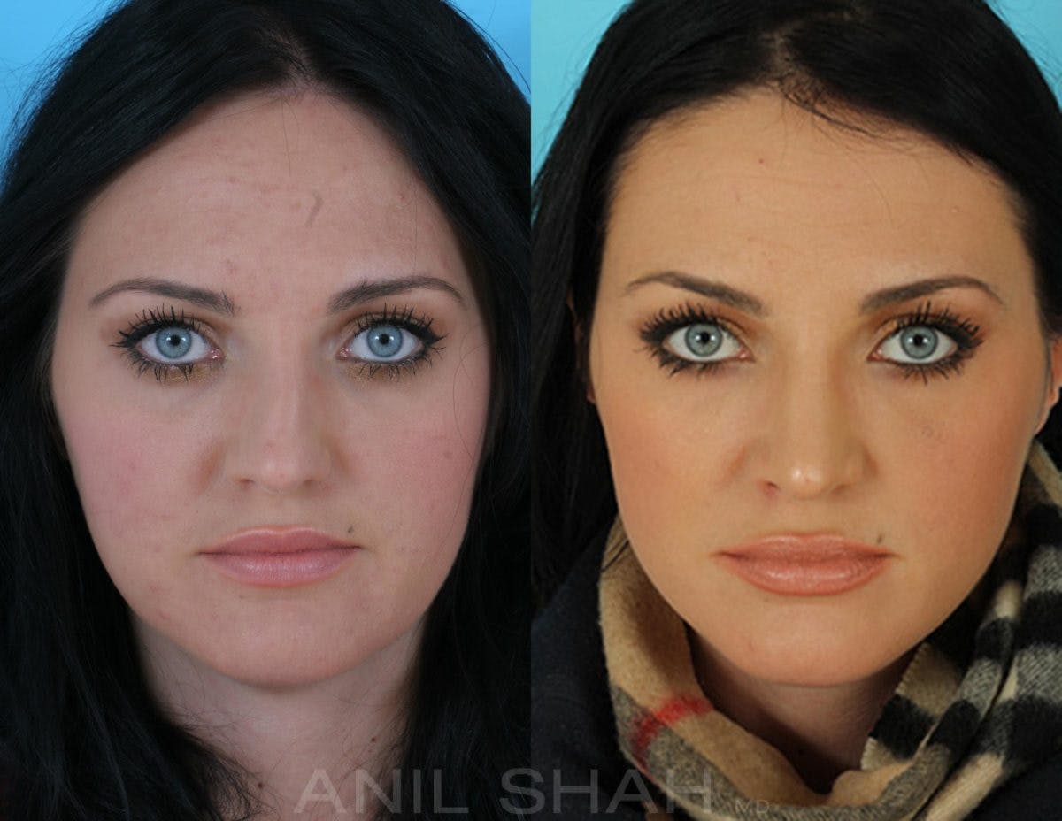 Rhinoplasty Before & After Gallery - Patient 238790 - Image 1