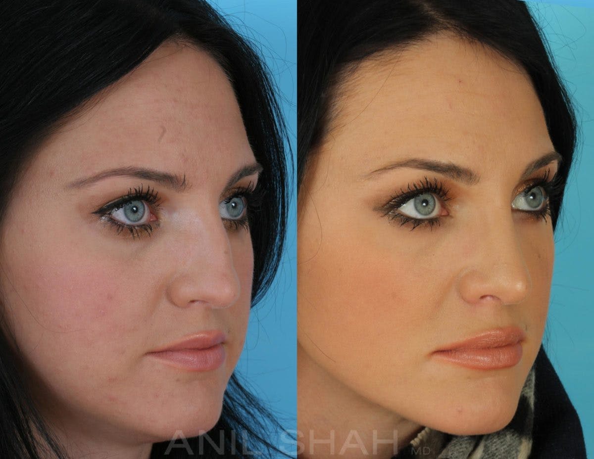 Rhinoplasty Before & After Gallery - Patient 238790 - Image 2