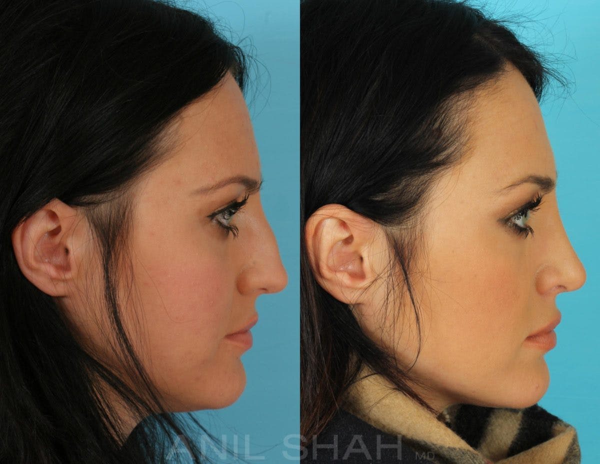 Rhinoplasty Before & After Gallery - Patient 238790 - Image 3
