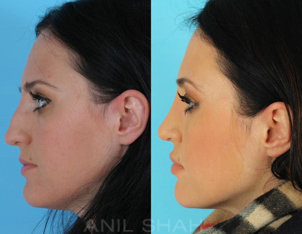 Rhinoplasty Before & After Gallery - Patient 238790 - Image 4