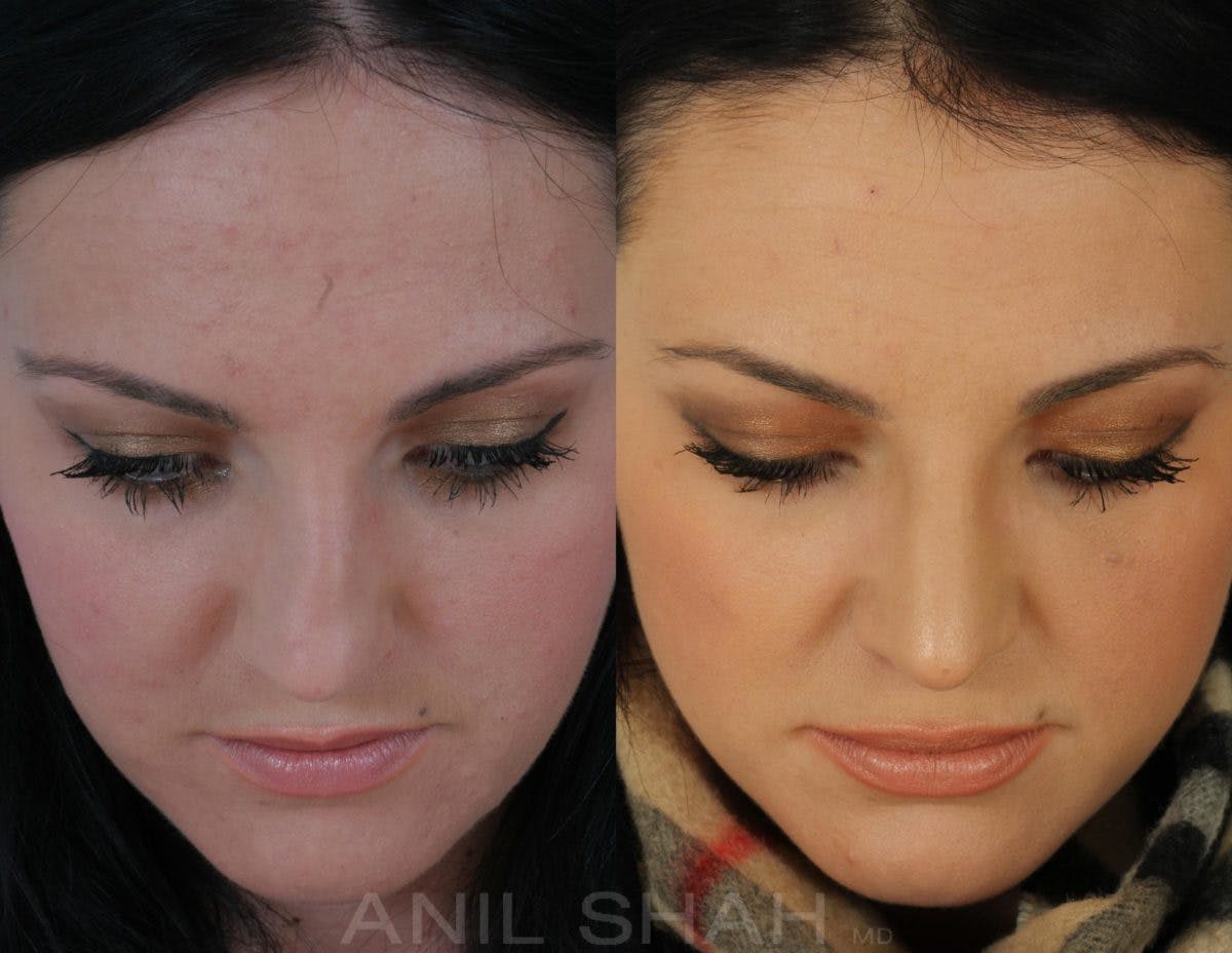 Rhinoplasty Before & After Gallery - Patient 238790 - Image 5