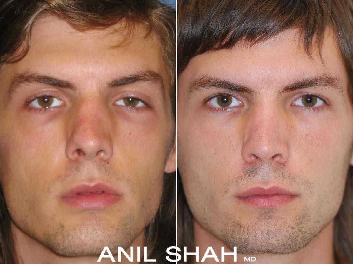 Rhinoplasty Before & After Gallery - Patient 282392 - Image 1