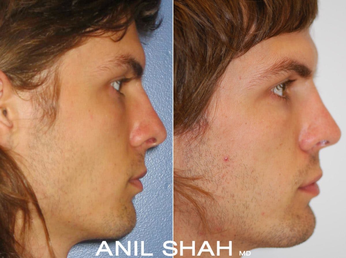 Rhinoplasty Before & After Gallery - Patient 282392 - Image 2
