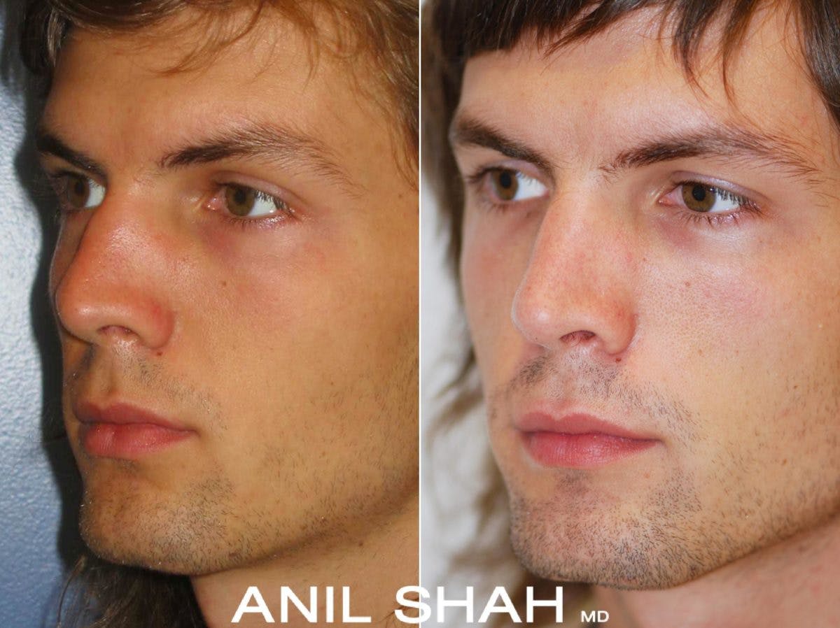 Rhinoplasty Before & After Gallery - Patient 282392 - Image 3
