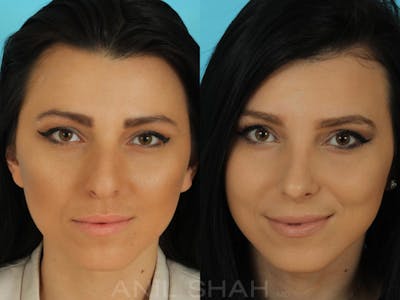 Rhinoplasty Before & After Gallery - Patient 332912 - Image 1