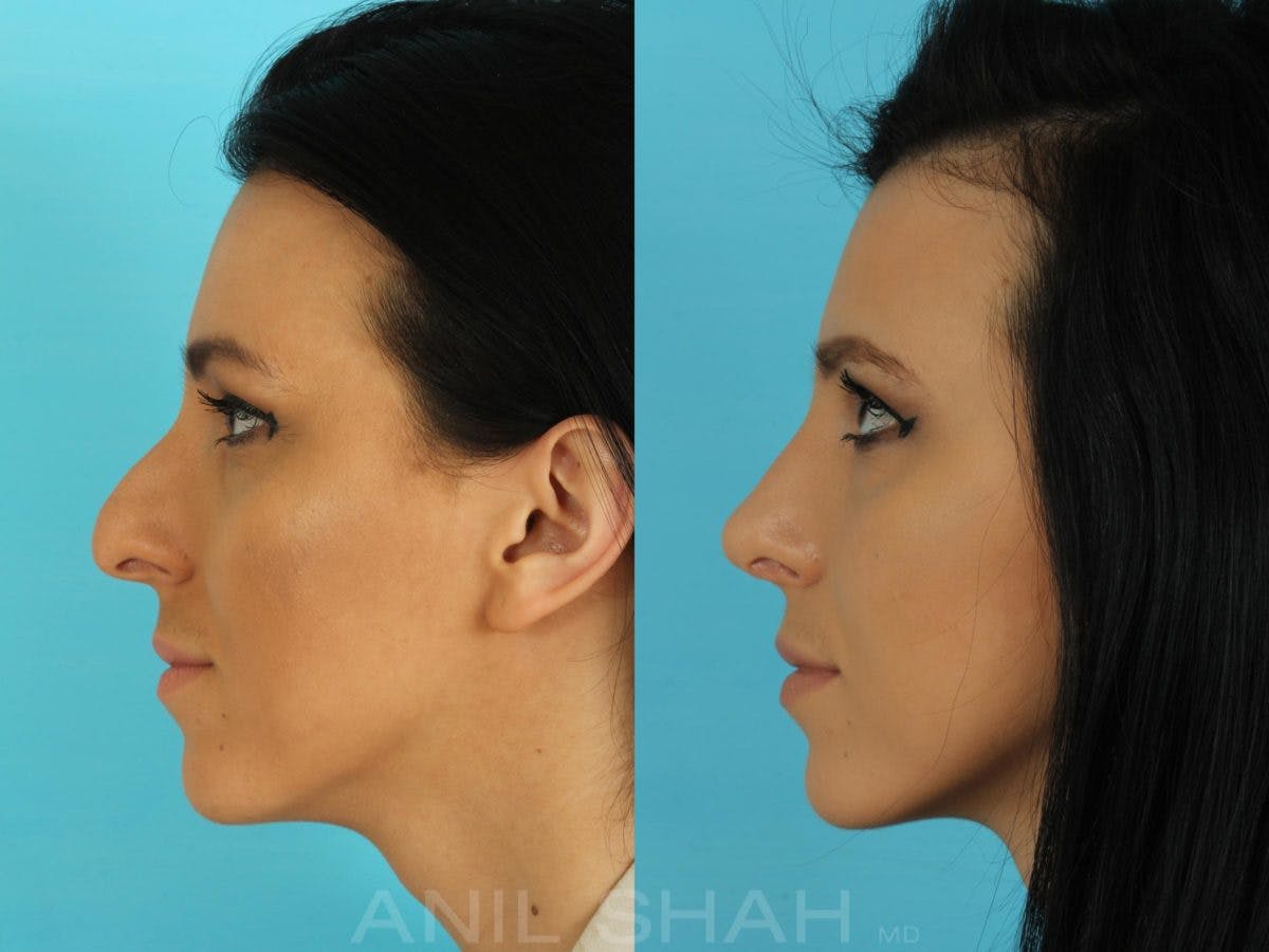 Rhinoplasty Before & After Gallery - Patient 332912 - Image 2