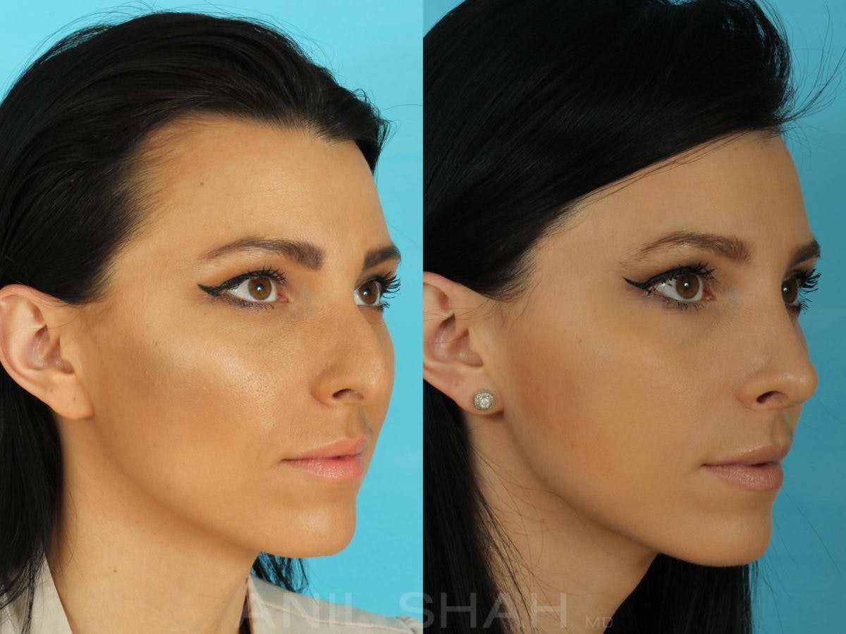 Rhinoplasty Before & After Gallery - Patient 332912 - Image 3