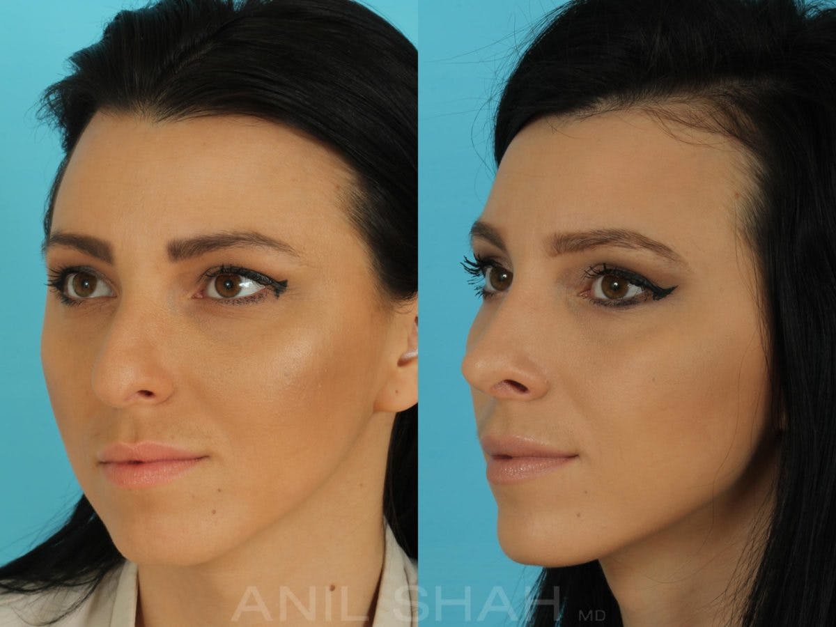 Rhinoplasty Before & After Gallery - Patient 332912 - Image 4