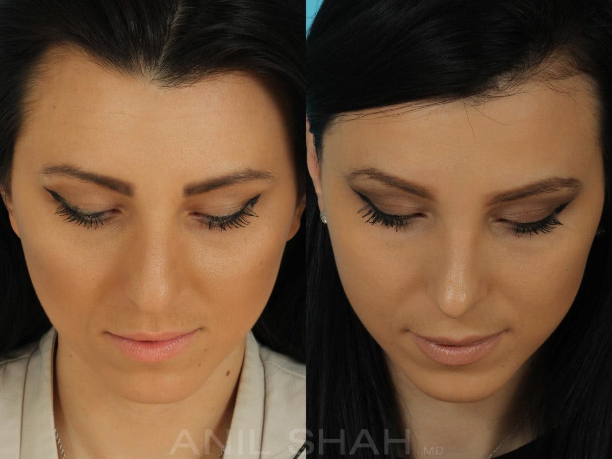 Rhinoplasty Before & After Gallery - Patient 332912 - Image 5