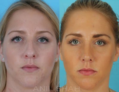 Rhinoplasty Before & After Gallery - Patient 270001 - Image 1