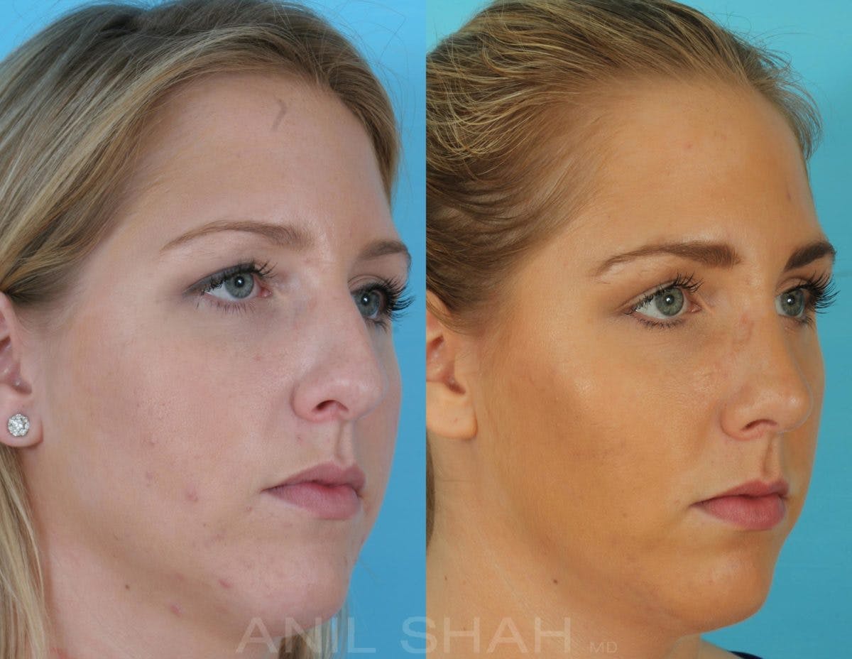 Rhinoplasty Before & After Gallery - Patient 270001 - Image 2