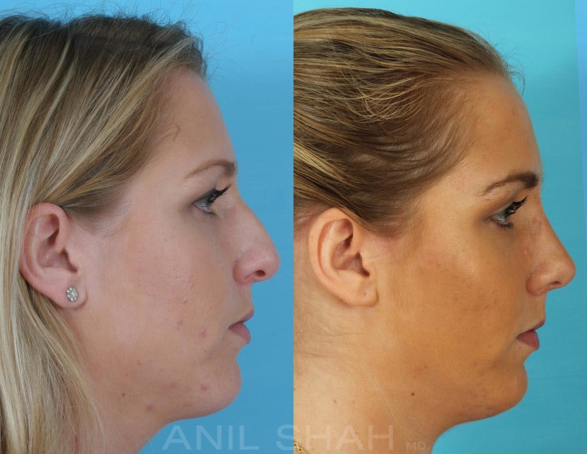 Rhinoplasty Before & After Gallery - Patient 270001 - Image 3