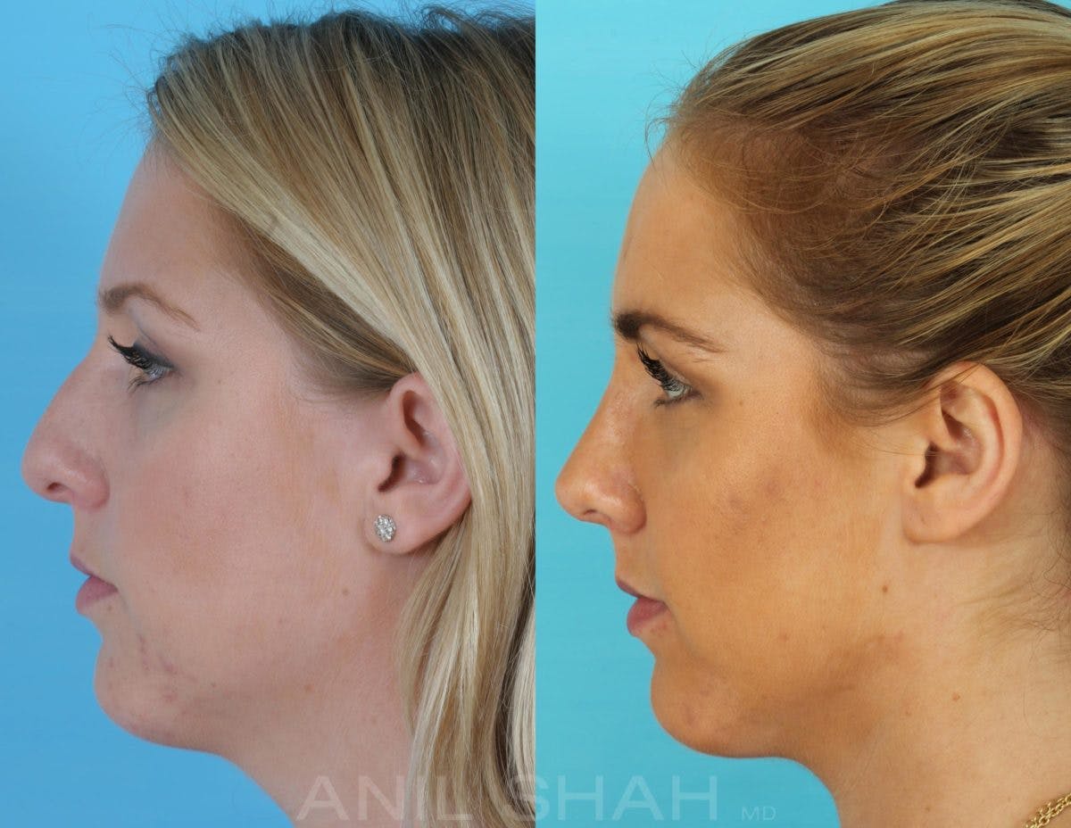 Rhinoplasty Before & After Gallery - Patient 270001 - Image 4