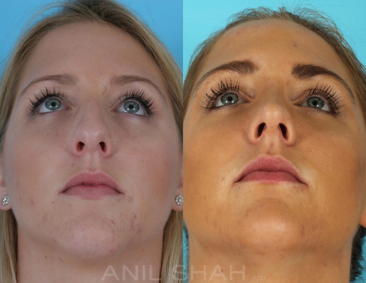 Rhinoplasty Before & After Gallery - Patient 270001 - Image 5