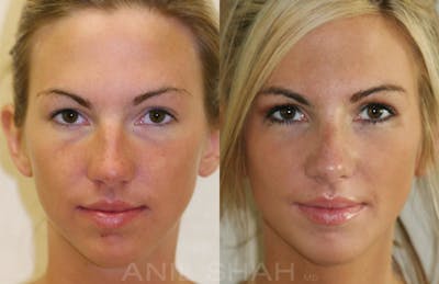 Rhinoplasty Before & After Gallery - Patient 157548 - Image 1
