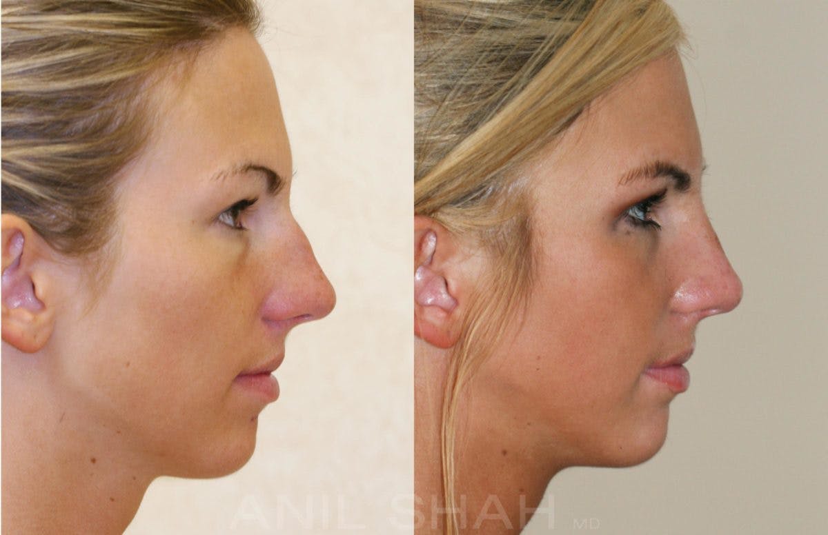 Rhinoplasty Before & After Gallery - Patient 157548 - Image 2