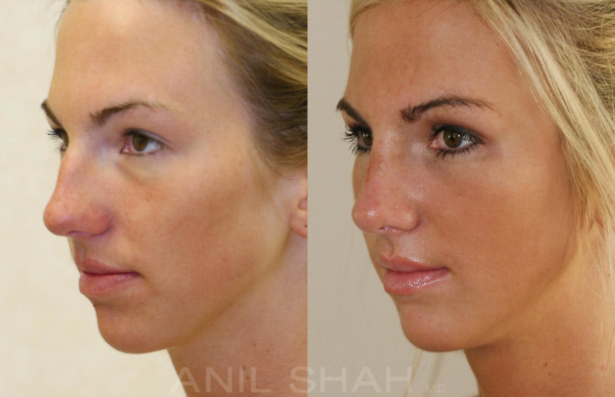 Rhinoplasty Before & After Gallery - Patient 157548 - Image 3