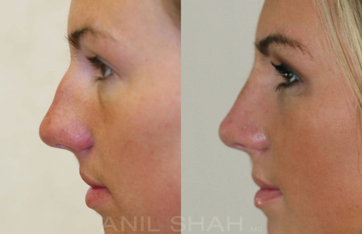 Rhinoplasty Before & After Gallery - Patient 157548 - Image 4