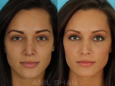 Rhinoplasty Before & After Gallery - Patient 793439 - Image 1
