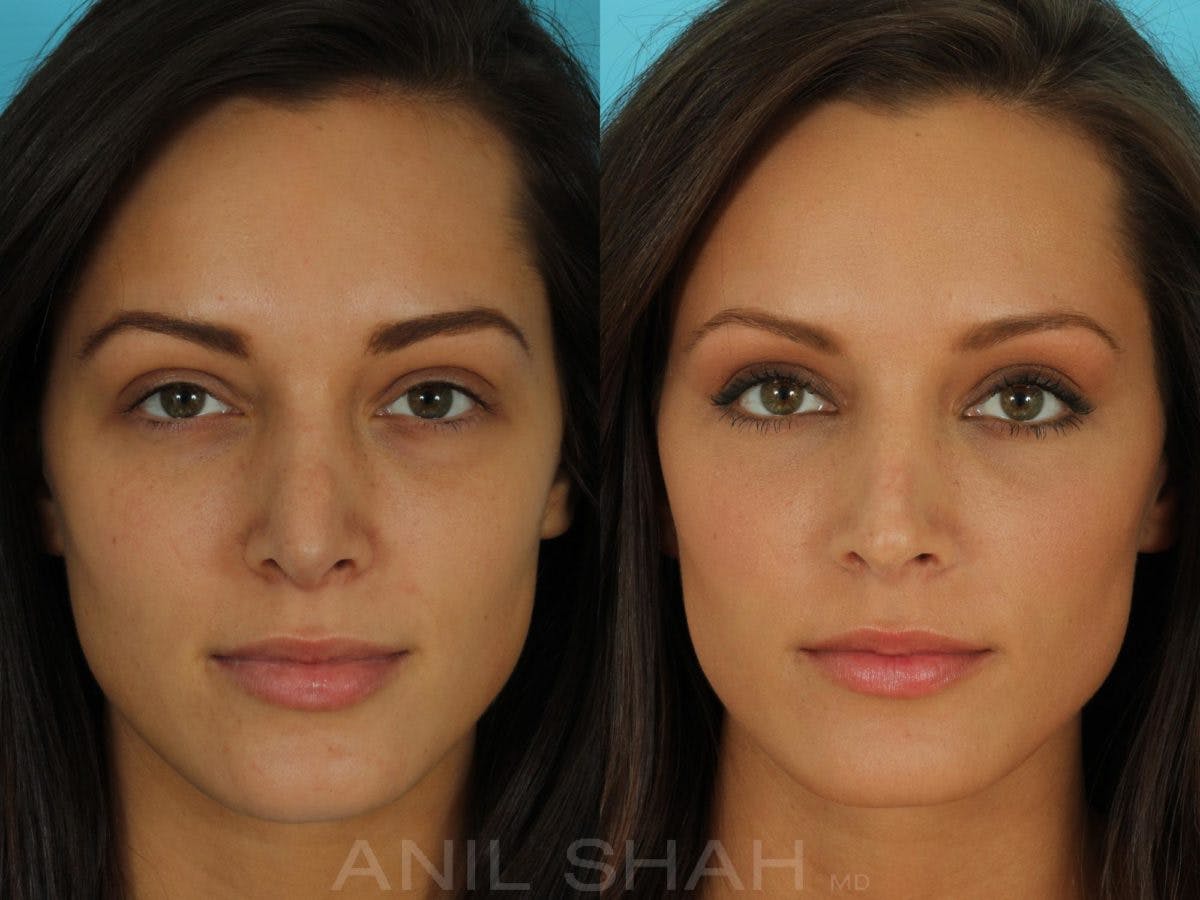Rhinoplasty Before & After Gallery - Patient 793439 - Image 1