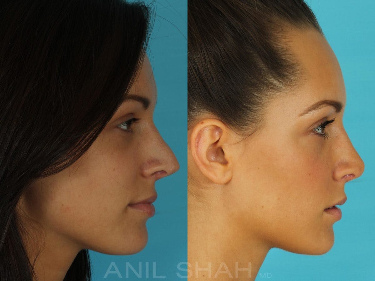 Rhinoplasty Before & After Gallery - Patient 793439 - Image 2