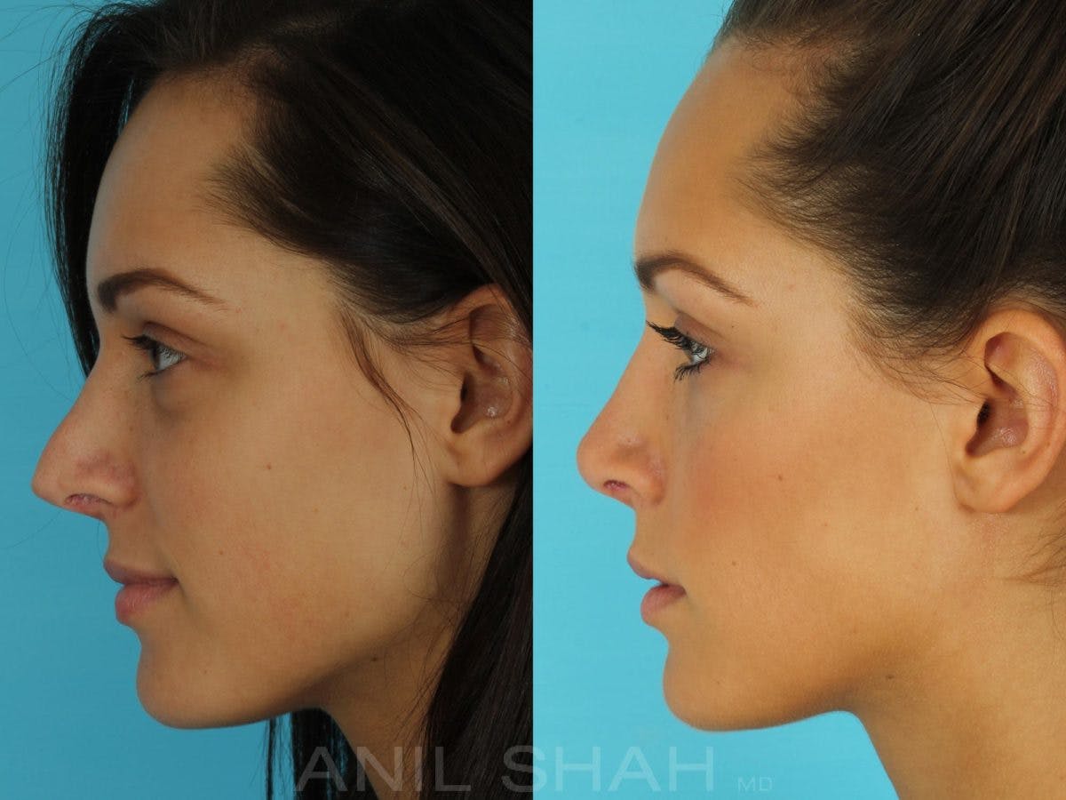 Rhinoplasty Before & After Gallery - Patient 793439 - Image 3