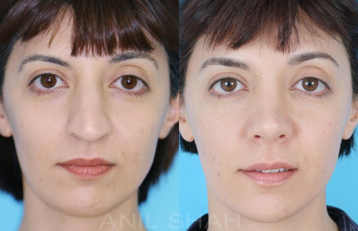 Rhinoplasty Before & After Gallery - Patient 182906 - Image 1