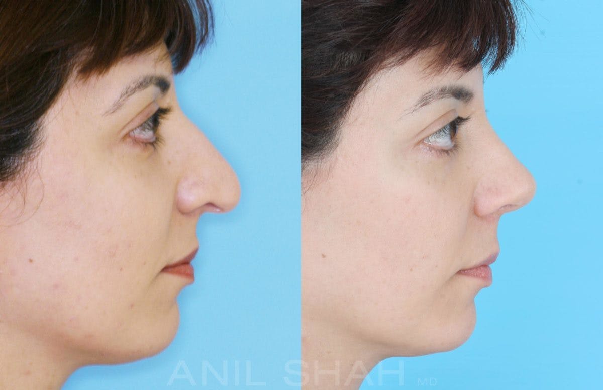 Rhinoplasty Before & After Gallery - Patient 182906 - Image 2