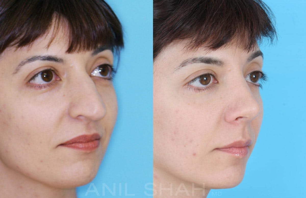 Rhinoplasty Before & After Gallery - Patient 182906 - Image 3