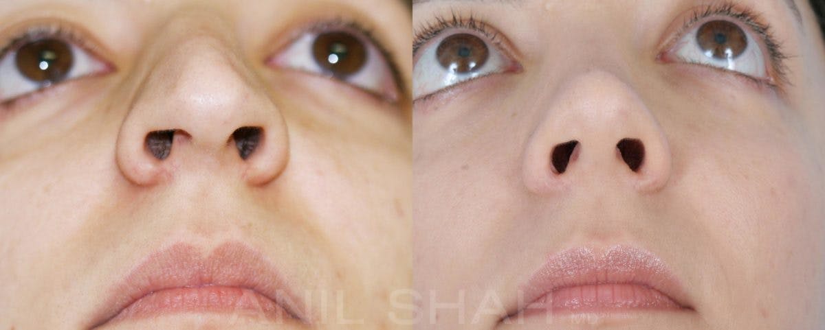 Rhinoplasty Before & After Gallery - Patient 182906 - Image 4