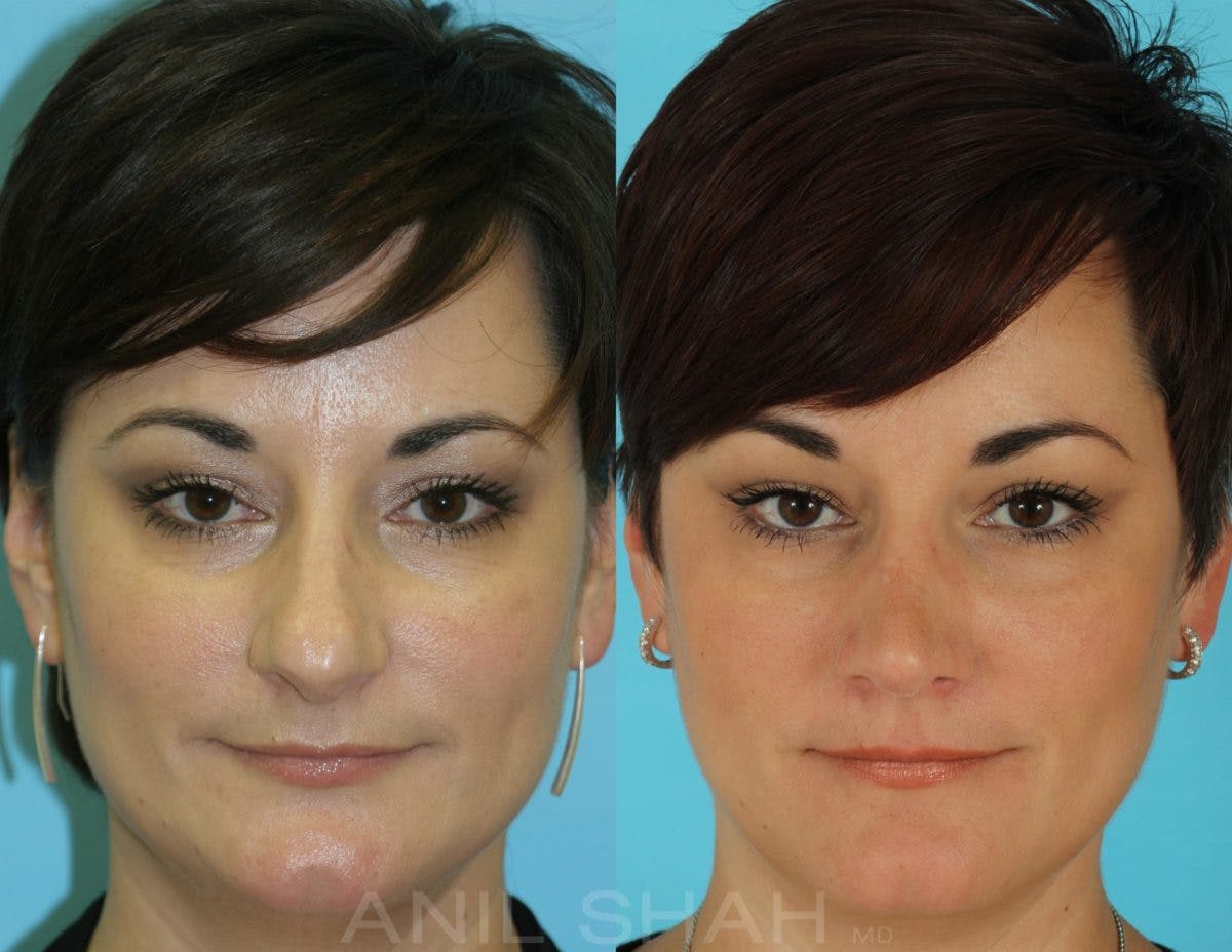 Rhinoplasty Before & After Gallery - Patient 592735 - Image 1