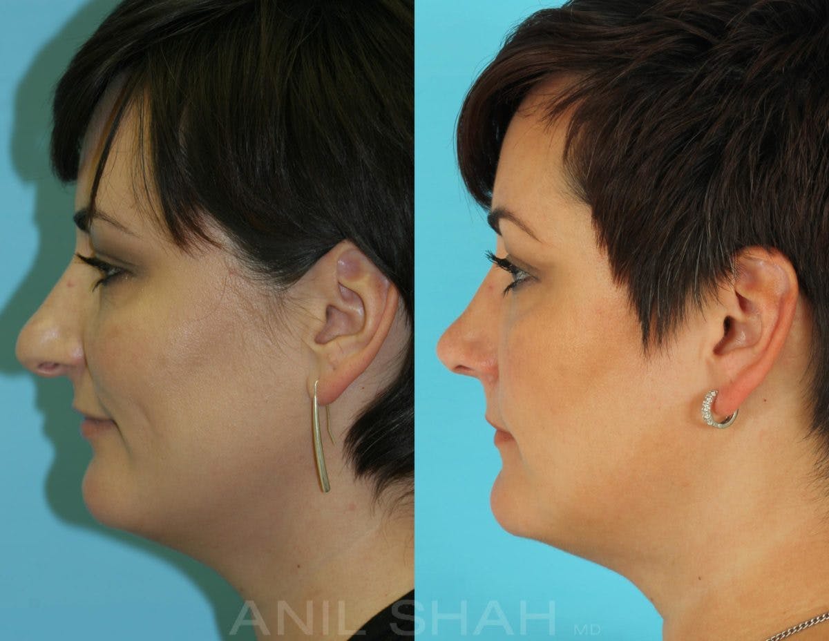 Rhinoplasty Before & After Gallery - Patient 592735 - Image 2