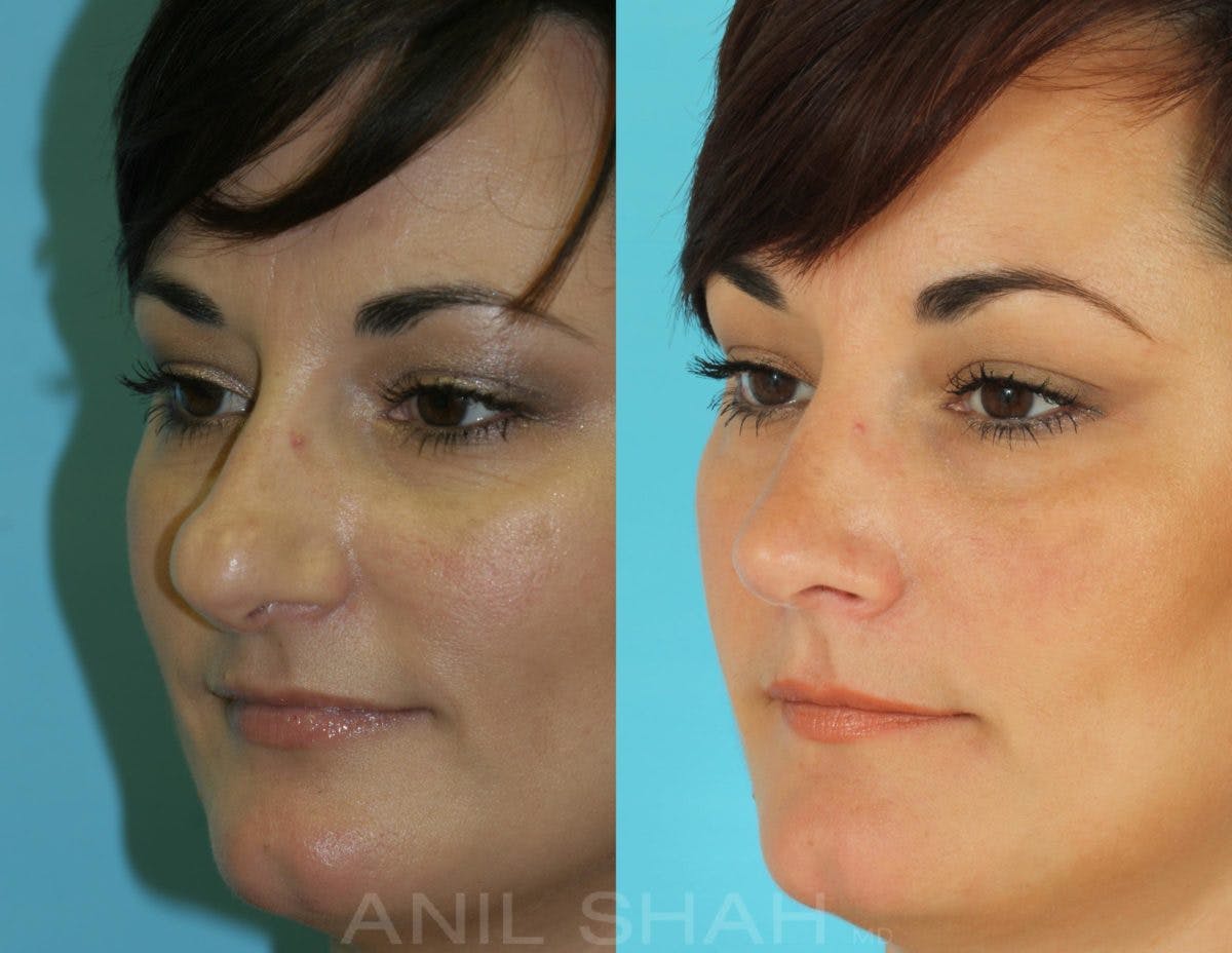 Rhinoplasty Before & After Gallery - Patient 592735 - Image 3
