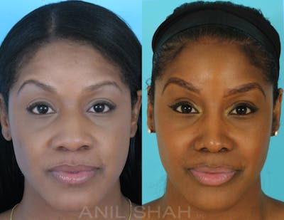 Rhinoplasty Before & After Gallery - Patient 885282 - Image 1