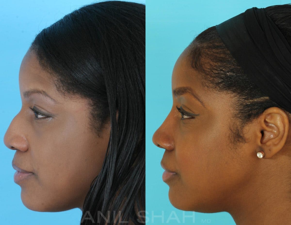 Rhinoplasty Before & After Gallery - Patient 885282 - Image 2