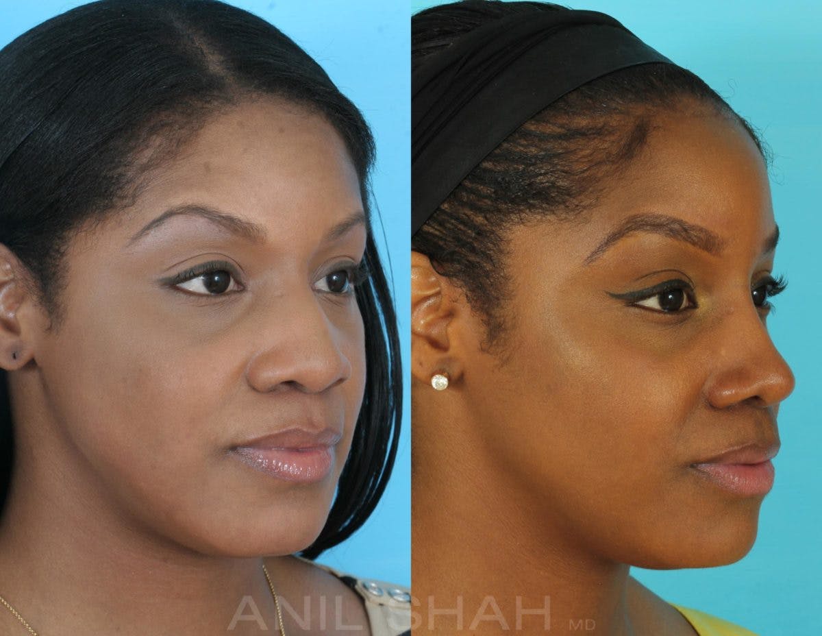 Rhinoplasty Before & After Gallery - Patient 885282 - Image 3
