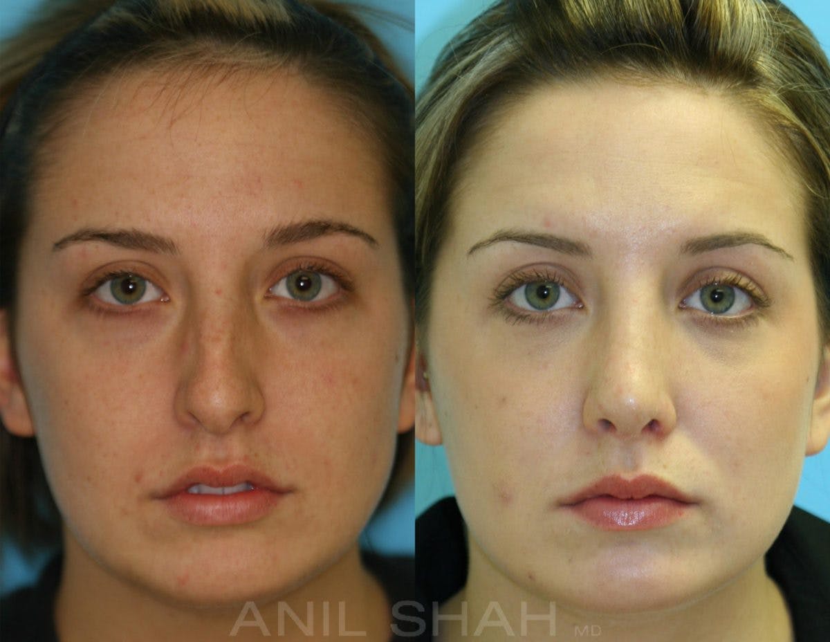 Rhinoplasty Before & After Gallery - Patient 150682 - Image 1