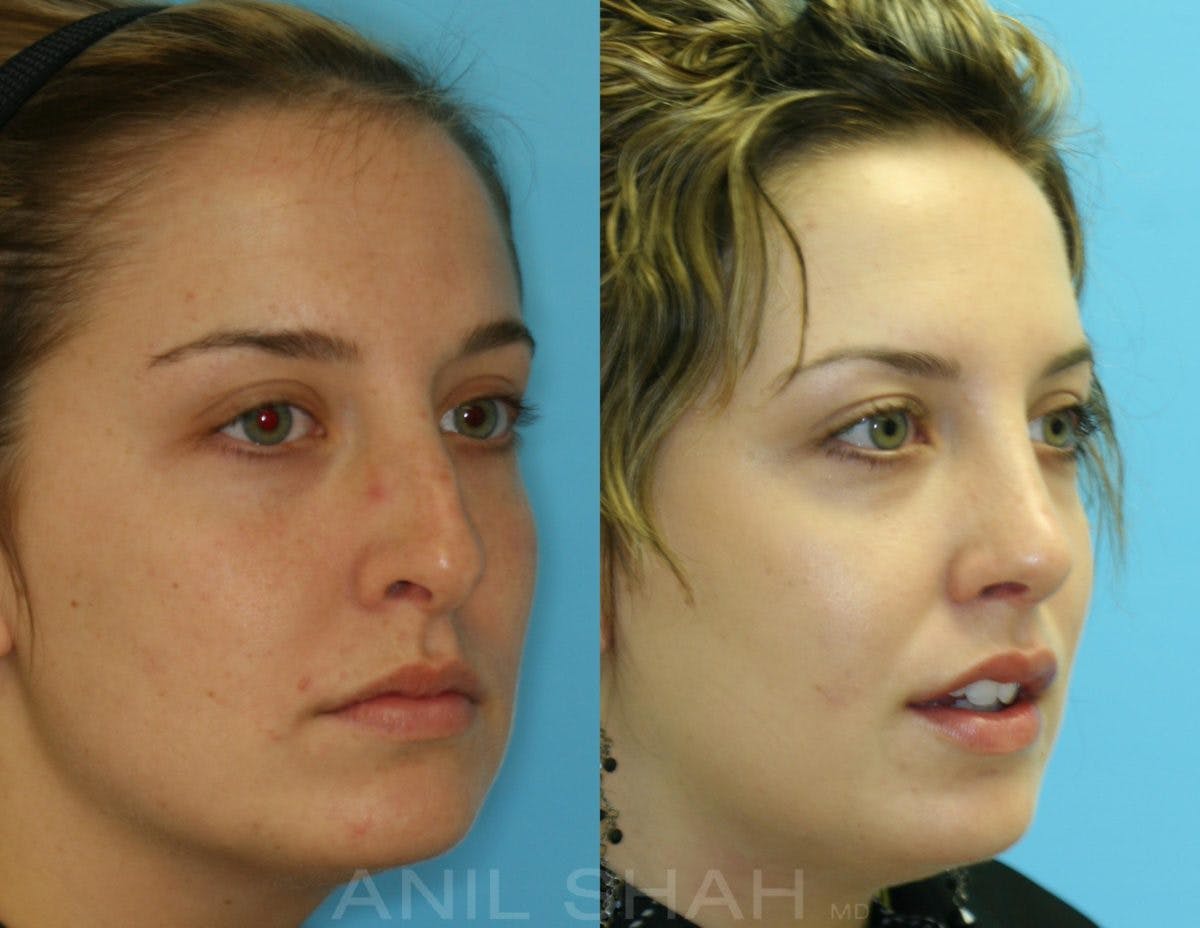 Rhinoplasty Before & After Gallery - Patient 150682 - Image 2