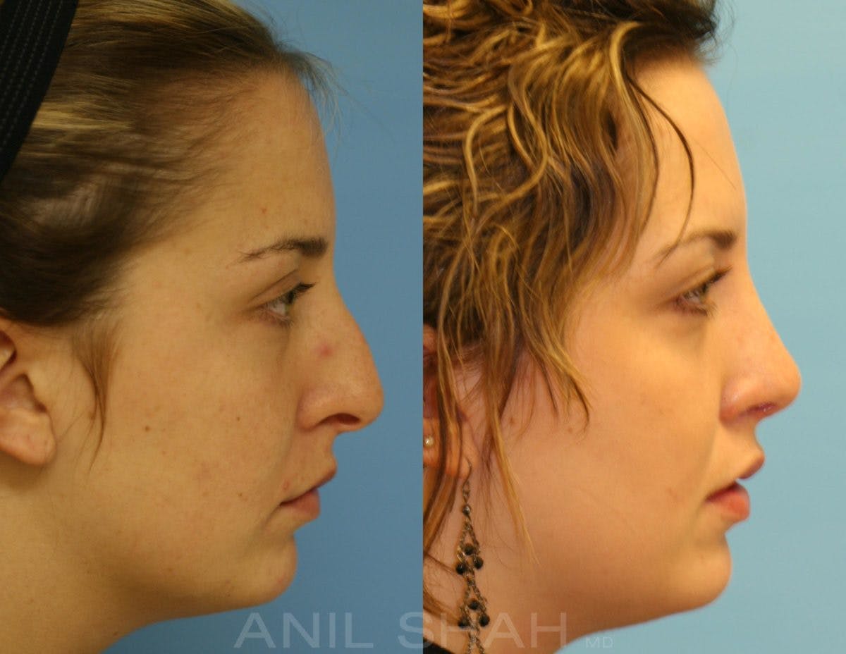 Rhinoplasty Before & After Gallery - Patient 150682 - Image 3