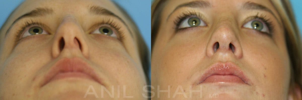 Rhinoplasty Before & After Gallery - Patient 150682 - Image 4