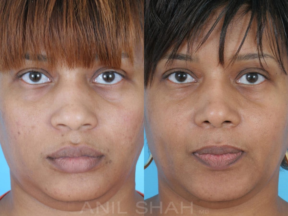 Rhinoplasty Before & After Gallery - Patient 345522 - Image 1