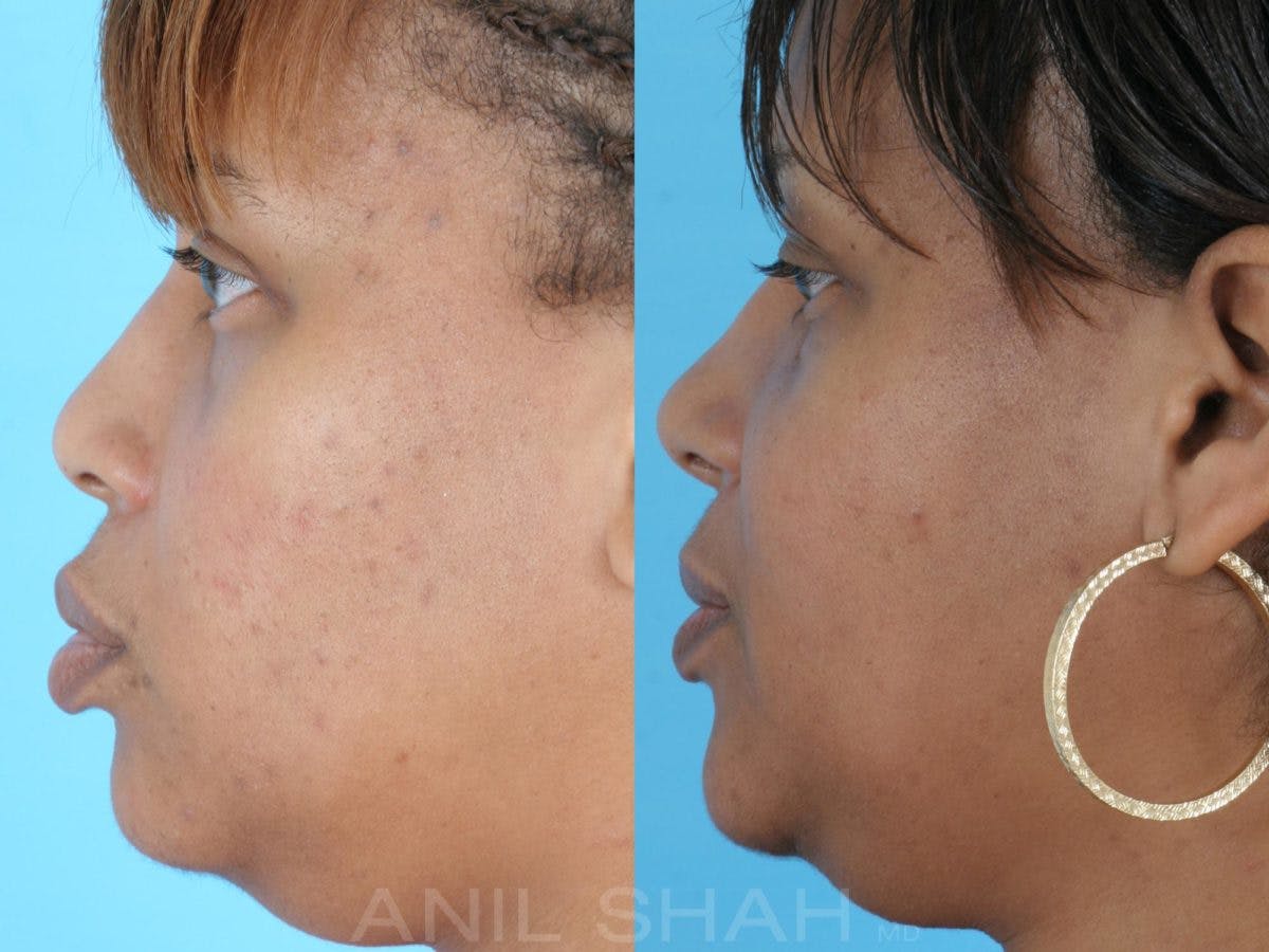 Rhinoplasty Before & After Gallery - Patient 345522 - Image 2